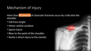 Comprehensive Overview of Clavicle Fractures: Anatomy, Diagnosis, and ...