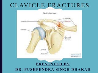CLAVICLE FRACTURES
PRESENTED BY
DR. PUSHPENDRA SINGH DHAKAD
 