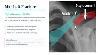 Midshaft Fracture
Highest Frequency: 69-82%
This is the most common presentation of clavicle injuries
due to the anatomical weakness of the middle third.
Superior displacement of medial fragment
Inferior displacement of lateral fragment
Pronounced fragment overlap & shortening
Clinical Relevance:
Displacement >2 cm signiﬁcantly increases the risk of nonunion
and long-term functional impairment.
 