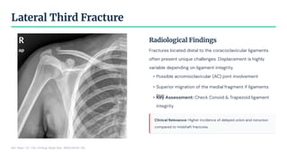 Radiological Findings
Fractures located distal to the coracoclavicular ligaments
often present unique challenges. Displacement is highly
variable depending on ligament integrity.
• Possible acromioclavicular (AC) joint involvement
• Superior migration of the medial fragment if ligaments
tear
• Key Assessment: Check Conoid & Trapezoid ligament
integrity
Clinical Relevance: Higher incidence of delayed union and nonunion
compared to midshaft fractures.
Lateral Third Fracture
Ref: Neer CS. Clin Orthop Relat Res. 1968;58:43-50.
 