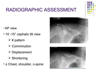 Clavicle fractures | PPT