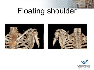 Floating shoulder
 