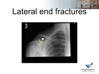 Lateral end fractures
 