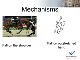 Mechanisms
Fall on the shoulder
Fall on outstretched
hand
 