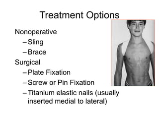 Treatment Options
Nonoperative
–Sling
–Brace
Surgical
–Plate Fixation
–Screw or Pin Fixation
–Titanium elastic nails (usually
inserted medial to lateral)
 