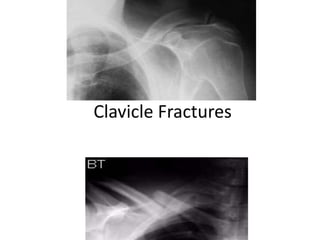 Clavicle Fractures
 