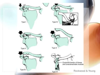 Clavicle Fractures & ACJ Injuries | PPTX