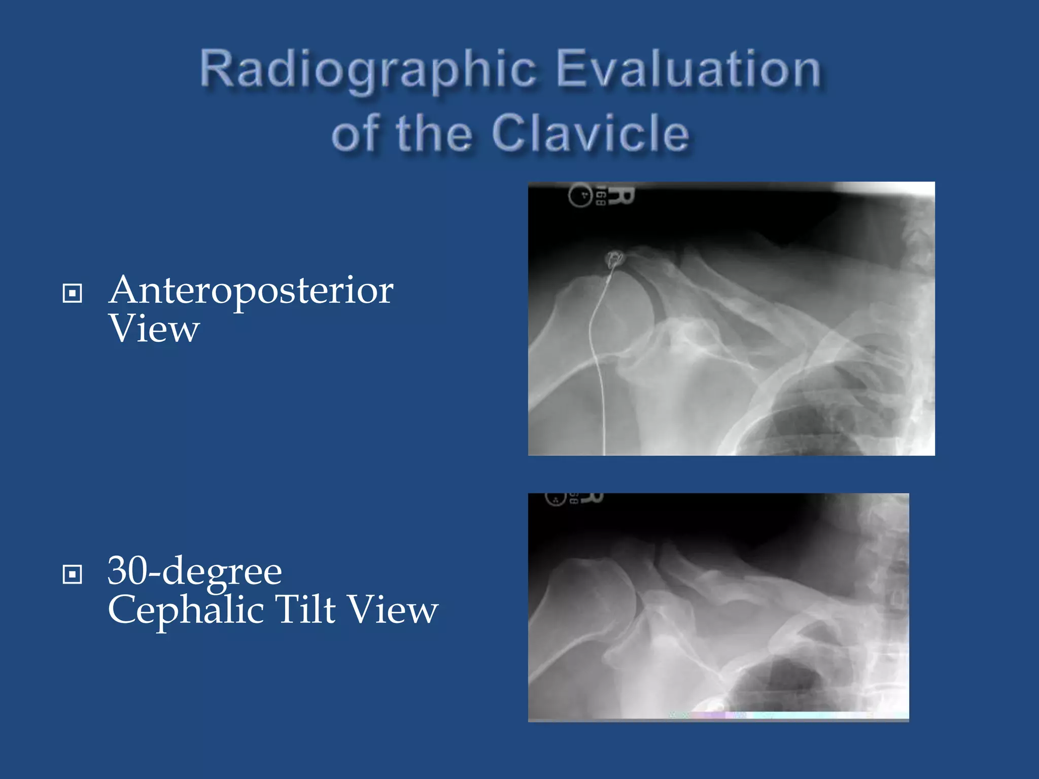 Clavicle fractures&acromio clavicular joint injuries | PPTX