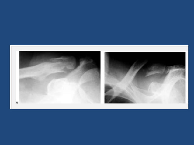 Clavicle fractures&acromio clavicular joint injuries | PPTX | Death ...