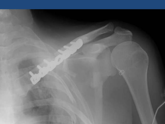 Clavicle fractures&acromio clavicular joint injuries | PPTX | Death ...