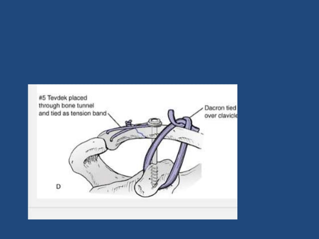 Clavicle fractures&acromio clavicular joint injuries | PPTX | Death ...