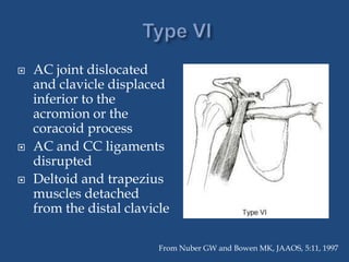 Clavicle fractures&acromio clavicular joint injuries | PPTX