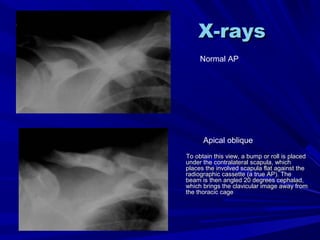 X-raysX-rays
To obtain this view, a bump or roll is placedTo obtain this view, a bump or roll is placed
under the contralateral scapula, whichunder the contralateral scapula, which
places the involved scapula flat against theplaces the involved scapula flat against the
radiographic cassette (a true AP). Theradiographic cassette (a true AP). The
beam is then angled 20 degrees cephalad,beam is then angled 20 degrees cephalad,
which brings the clavicular image away fromwhich brings the clavicular image away from
the thoracic cagethe thoracic cage
Normal AP
Apical oblique
 