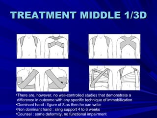 TREATMENT MIDDLE 1/3DTREATMENT MIDDLE 1/3D
•There are, however, no well-controlled studies that demonstrate a
difference in outcome with any specific technique of immobilization
•Dominant hand : figure of 8 as then he can write
•Non dominant hand : sling support 4 to 6 weeks
•Counsel : some deformity, no functional impairment
 