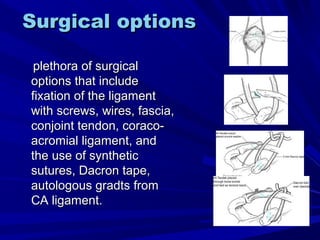 Surgical optionsSurgical options
plethora of surgicalplethora of surgical
options that includeoptions that include
fixation of the ligamentfixation of the ligament
with screws, wires, fascia,with screws, wires, fascia,
conjoint tendon, coraco-conjoint tendon, coraco-
acromial ligament, andacromial ligament, and
the use of syntheticthe use of synthetic
sutures, Dacron tape,sutures, Dacron tape,
autologous gradts fromautologous gradts from
CA ligament.CA ligament.
 