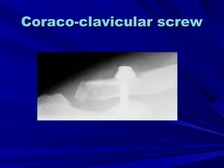 Coraco-clavicular screwCoraco-clavicular screw
 
