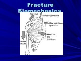 FractureFracture
BiomechanicsBiomechanics
 