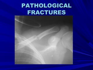 PATHOLOGICALPATHOLOGICAL
FRACTURESFRACTURES
 
