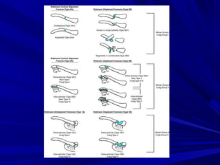 Claviclefrctures