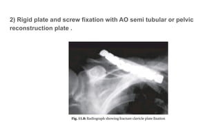 Semi Rigid Fixation Examples MBBS ORTHOPAEDICS Fracture of Clavicle new.pptx