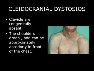 CLEIDOCRANIAL DYSTOSIOS
• Clavicle are
congenitally
absent.
• The shoulders
droop , and can be
approximately
anteriorly in front
of the chest.
 
