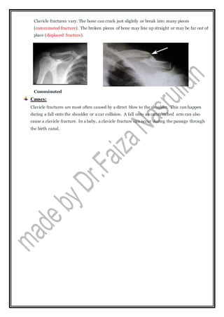 Clavicle fractures vary. The bone can crack just slightly or break into many pieces
(comminuted fracture). The broken pieces of bone may line up straight or may be far out of
place (displaced fracture).
Comminuted
Causes:
Clavicle fractures are most often caused by a direct blow to the shoulder. This can happen
during a fall onto the shoulder or a car collision. A fall onto an outstretched arm can also
cause a clavicle fracture. In a baby, a clavicle fracture can occur during the passage through
the birth canal.
 