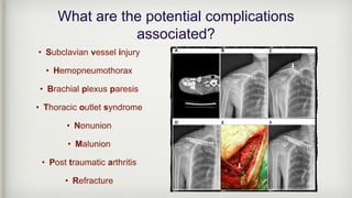What are the potential complications
associated?
• Subclavian vessel injury
• Hemopneumothorax
• Brachial plexus paresis
• Thoracic outlet syndrome
• Nonunion
• Malunion
• Post traumatic arthritis
• Refracture
 