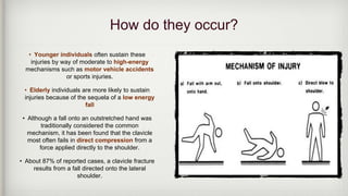 How do they occur?
• Younger individuals often sustain these
injuries by way of moderate to high-energy
mechanisms such as motor vehicle accidents
or sports injuries.
• Elderly individuals are more likely to sustain
injuries because of the sequela of a low energy
fall
• Although a fall onto an outstretched hand was
traditionally considered the common
mechanism, it has been found that the clavicle
most often fails in direct compression from a
force applied directly to the shoulder.
• About 87% of reported cases, a clavicle fracture
results from a fall directed onto the lateral
shoulder.
 