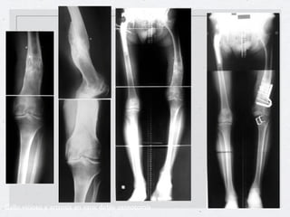 Callo vicioso y artrosis en varo: doble osteotomía
 