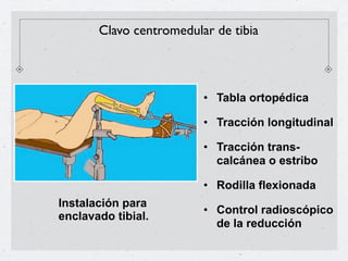 Clavo centromedular de tibia



                         • Tabla ortopédica

                         • Tracción longitudinal

                         • Tracción trans-
                           calcánea o estribo

                         • Rodilla flexionada
Instalación para
                         • Control radioscópico
enclavado tibial.
                           de la reducción
 