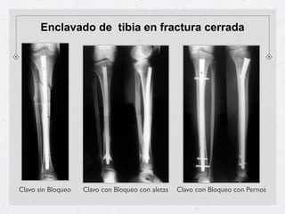 Enclavado de tibia en fractura cerrada




Clavo sin Bloqueo   Clavo con Bloqueo con aletas   Clavo con Bloqueo con Pernos
 