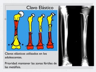 Clavo Elástico




Clavos elásticos utilizados en los
adolescentes.
Prioridad: mantener las zonas fértiles de
las metáﬁsis.
 