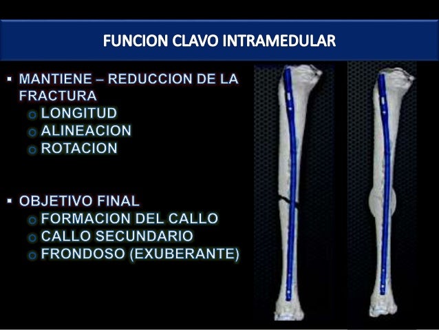 Amputacion supracondilea femoral pdf to excel