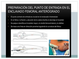 Clavos Endomedulares.pptx