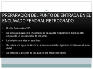 Clavos Endomedulares.pptx