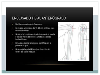 Clavos Endomedulares.pptx