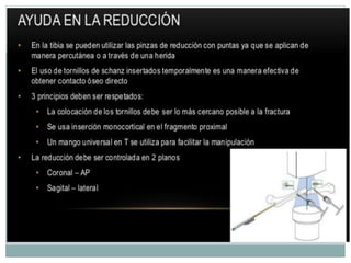 Clavos Endomedulares.pptx