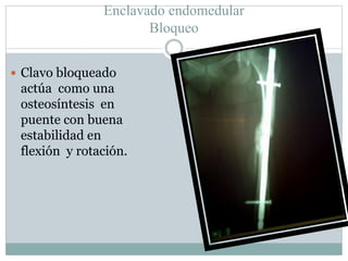 Enclavado endomedular
Bloqueo
 Clavo bloqueado
actúa como una
osteosíntesis en
puente con buena
estabilidad en
flexión y rotación.
 
