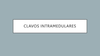 CLAVOS INTRAMEDULARES
 