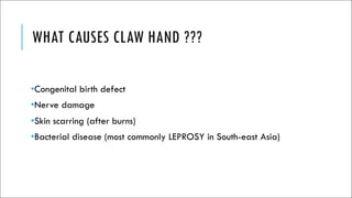 WHAT CAUSES CLAW HAND ???
•Congenital birth defect
•Nerve damage
•Skin scarring (after burns)
•Bacterial disease (most commonly LEPROSY in South-east Asia)
 