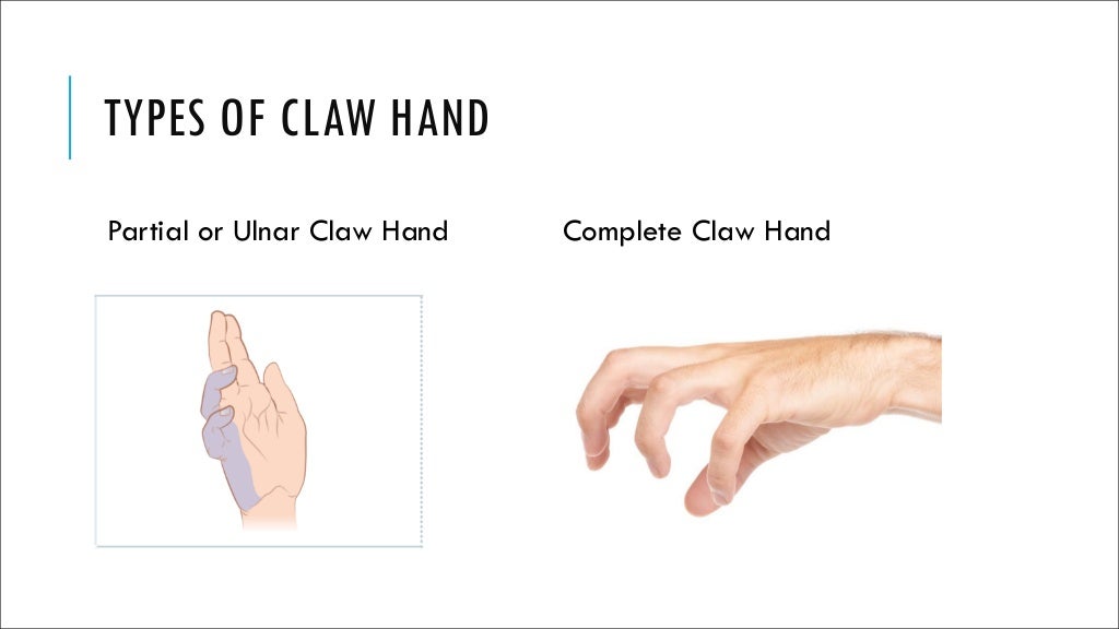 Claw Hand