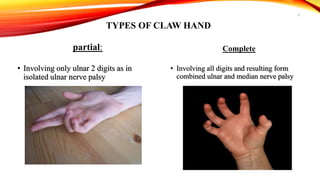 Claw Hand,Definition,Causes,Types,Symptoms and Management