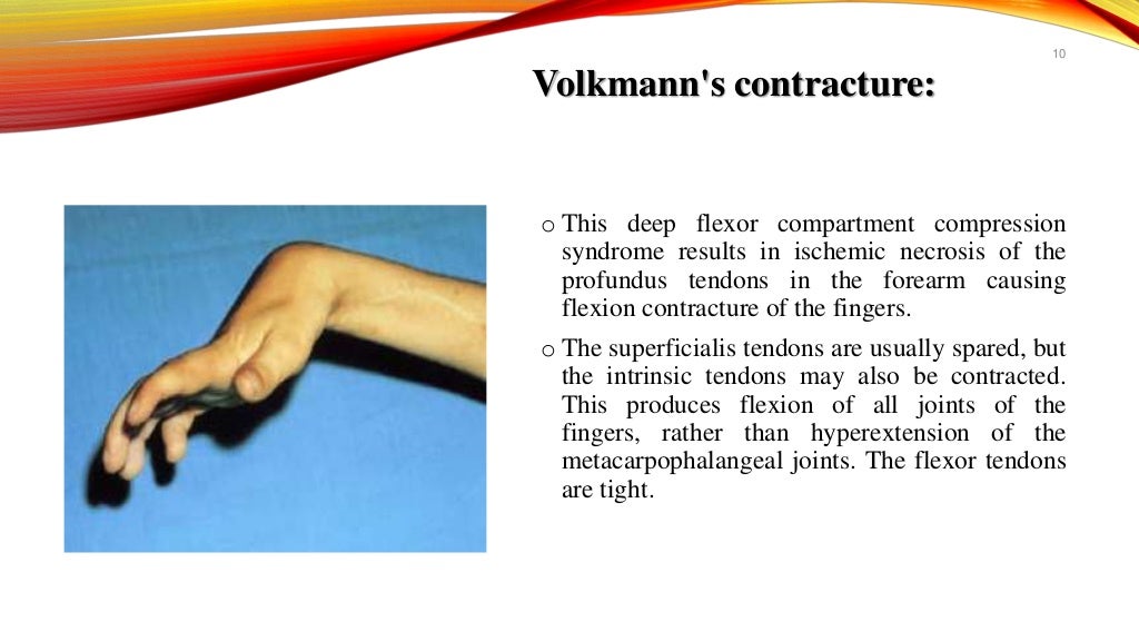 Claw Hand,Definition,Causes,Types,Symptoms and Management