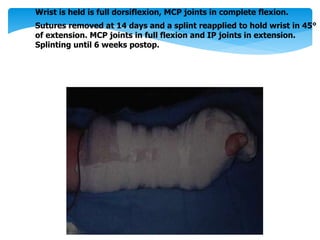 Wrist is held is full dorsiflexion, MCP joints in complete flexion. 
Sutures removed at 14 days and a splint reapplied to hold wrist in 45° 
of extension. MCP joints in full flexion and IP joints in extension. 
Splinting until 6 weeks postop. 
 