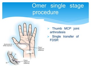 Omer single stage 
procedure 
 Thumb MCP joint 
arthrodesis 
 Single transfer of 
FDSR 
 