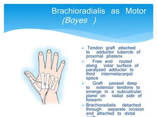 Brachioradialis as Motor 
(Boyes ) 
 Tendon graft attached 
to adductor tubercle of 
proximal phalanx 
 Free end routed 
along volar surface of 
paralyzed adductor to 
third intermetacarpal 
space 
 Graft passed deep 
to extensor tendons to 
emerge in a subcuticular 
plane on radial side of 
forearm 
 Brachioradialis detached 
through separate incision 
and attached to distal 
graft 
 