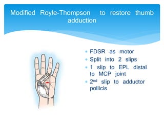 Modified Royle-Thompson to restore thumb 
adduction 
 FDSR as motor 
 Split into 2 slips 
 1 slip to EPL distal 
to MCP joint 
 2nd slip to adductor 
pollicis 
 