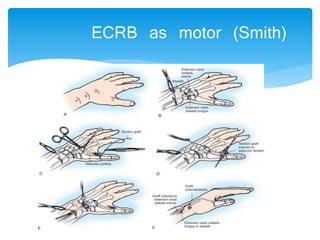 ECRB as motor (Smith) 
 
