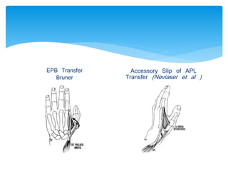 EPB Transfer 
Bruner 
Accessory Slip of APL 
Transfer (Neviaser et al ) 
 