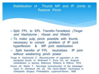 Stabilization of Thumb MP and IP Joints to 
Restore Pinch 
 Split FPL to EPL Transfer-Tenodesis (Tsuge 
and Hashizume ; House and Walsh) 
 To make pulp pinch possible with thumb, 
necessary to correct problem of IP joint 
hyperflexion & MP joint stabilization 
 Split transfer of FPL neutralizes IP joint 
without weakening pinch power 
Tsuge K, Hashizume C: Reconstruction of opposition in the 
paralyzed thumb . In: McDowell F, Enna CD, ed. Surgical 
rehabilitation in leprosy , Baltimore: Williams & Wilkins; 1974: 
House JH, Walsh T: Two-stage reconstruction of the tetraplegic 
hand . In: Strickland JW, ed. The Hand—Master Techniques in 
Orthopedic Surgery , Philadelphia: Lippincott-Raven; 1998 
 